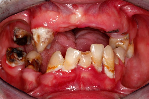 Extracting Teeth For Dentures Cruger MS 38924